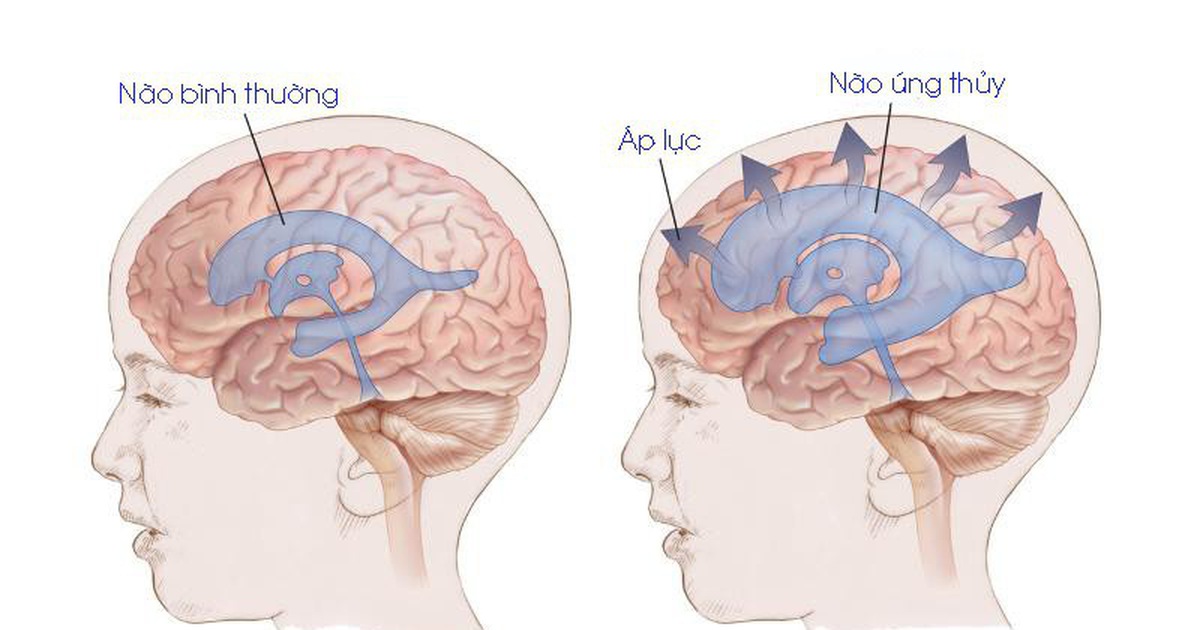 Ảnh 2 của Não úng thuỷ áp lực bình thường
